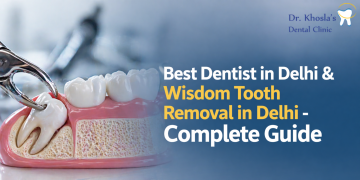 Best Dentist in Delhi & Wisdom Tooth Removal in Delhi – Complete Guide